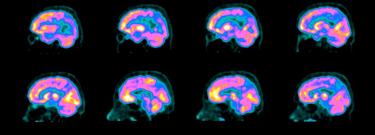 A Long-Sought Blood Test for Alzheimer’s is in Reach Featured Image